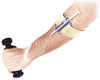 Thallium Injection Shield